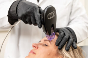 An Enrichment Skin Solutions provider positions the Morpheus8 device near a female patient's brow. Morpheus8 near Maple Grove can minimize fine lines and wrinkles on the forehead by stimulating collagen production.