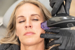 A close up of a female Enrichment Skin Solutions patient as her provider gently stamps the Morpheus8's microneedles into her skin for during her appointment for Morpheus8 near Maple Grove.