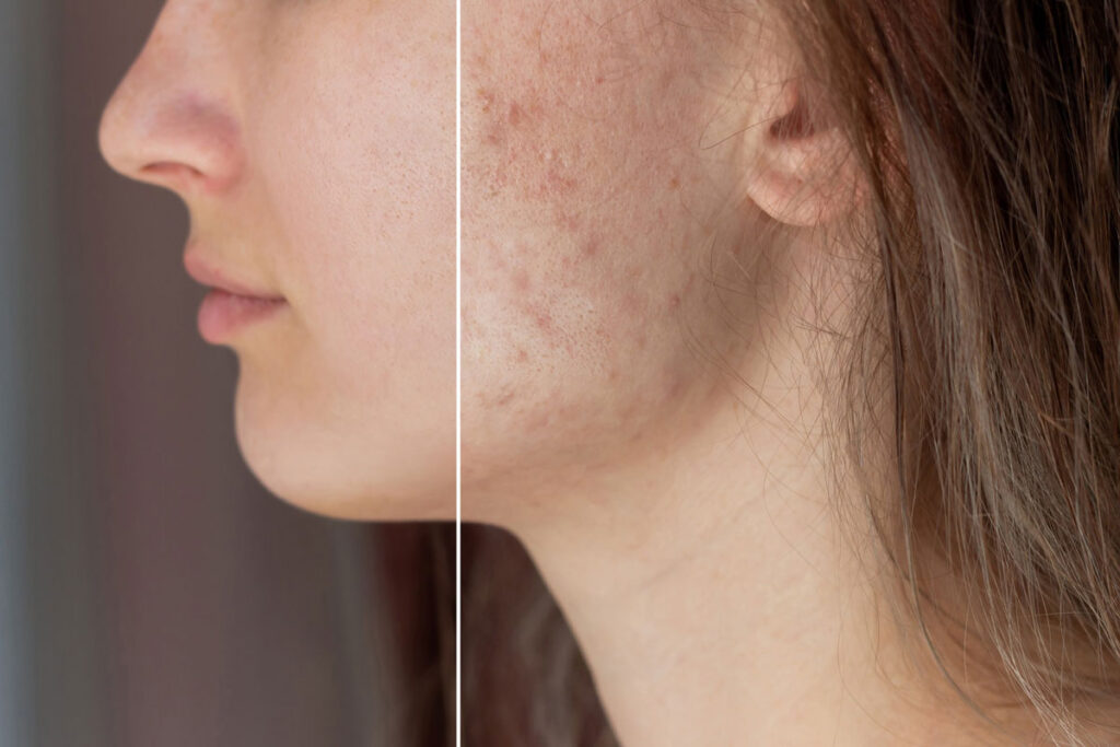 acne scar treatment