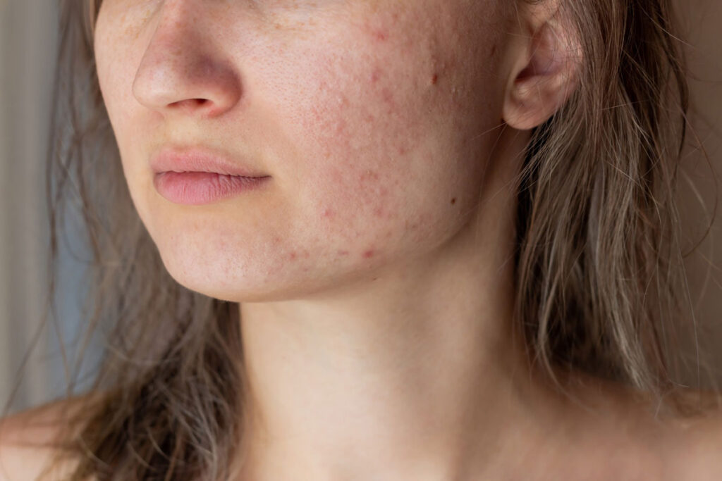 acne scars