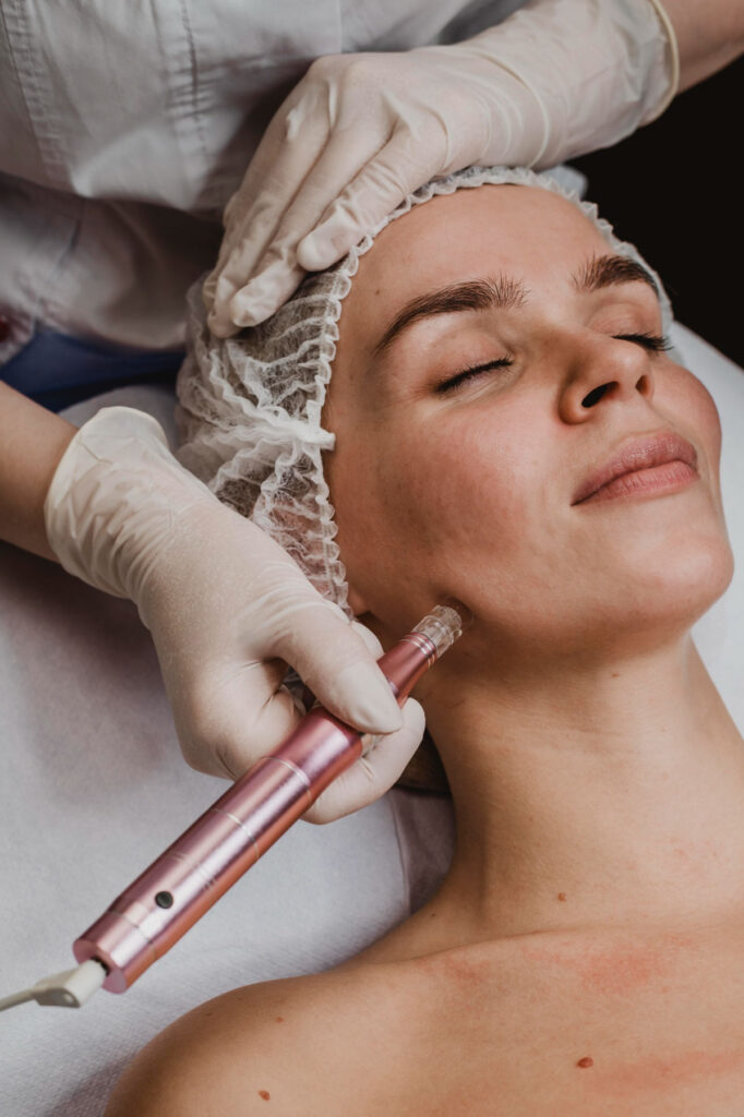 microneedling treatment