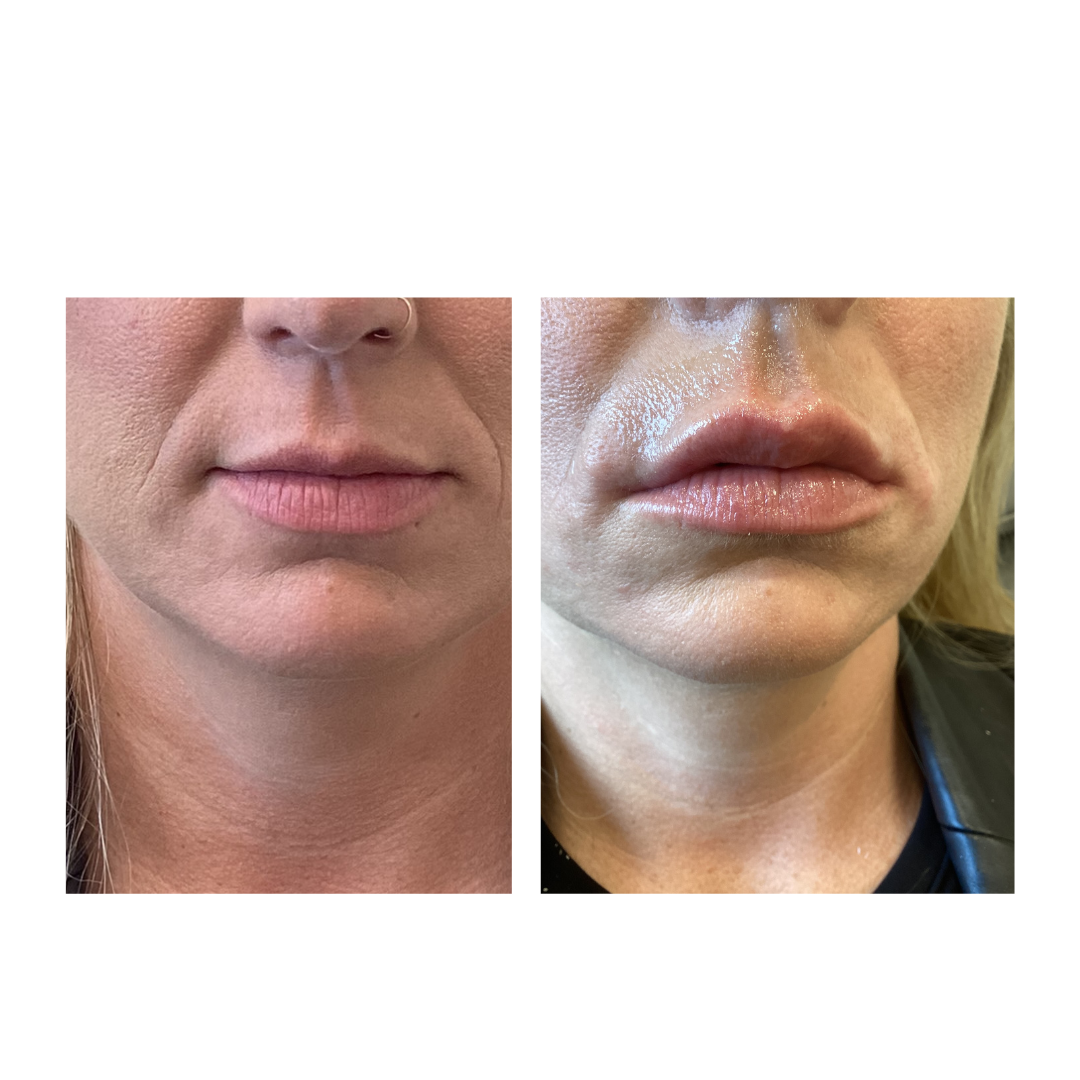 Enrichment Skin Solutions Lip Filler, Brooklyn Park