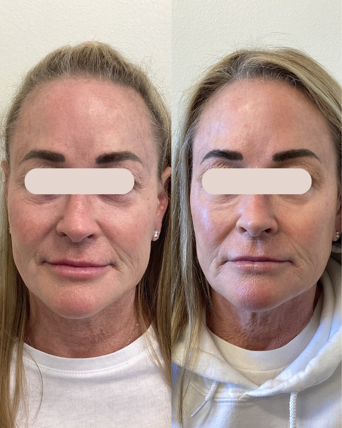 Sculptra treatment results near Minneapolis at Enrichment Skin Solutions
