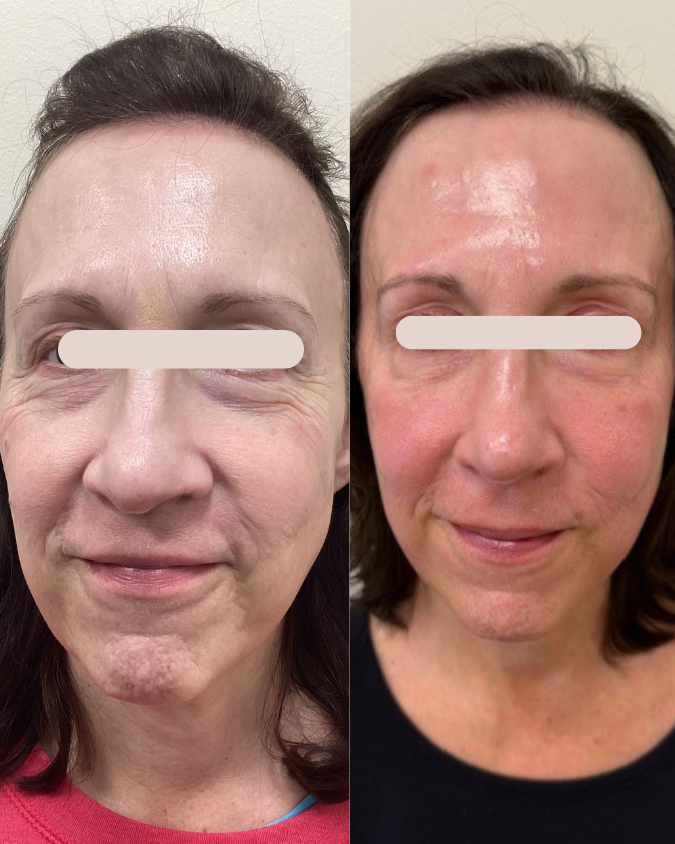 Enrichment Skin Solutions Sculptra Bio stimulation Treatment