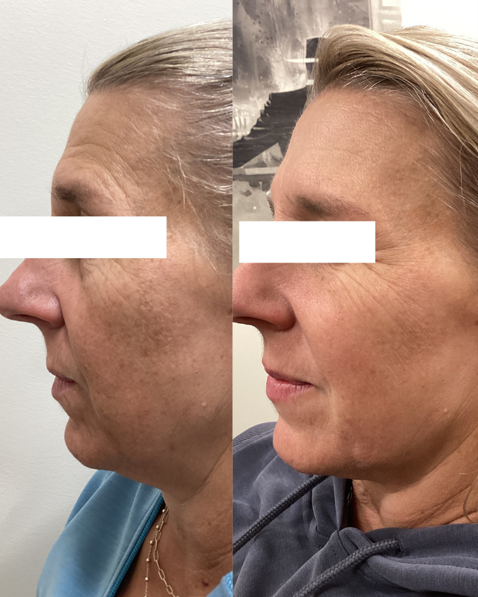 Before and after face sunspots